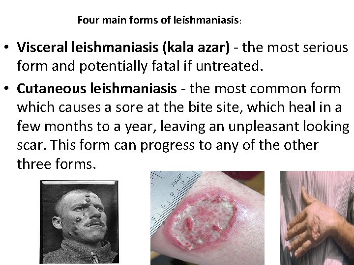 Four main forms of leishmaniasis: • Visceral leishmaniasis (kala azar) - the most serious