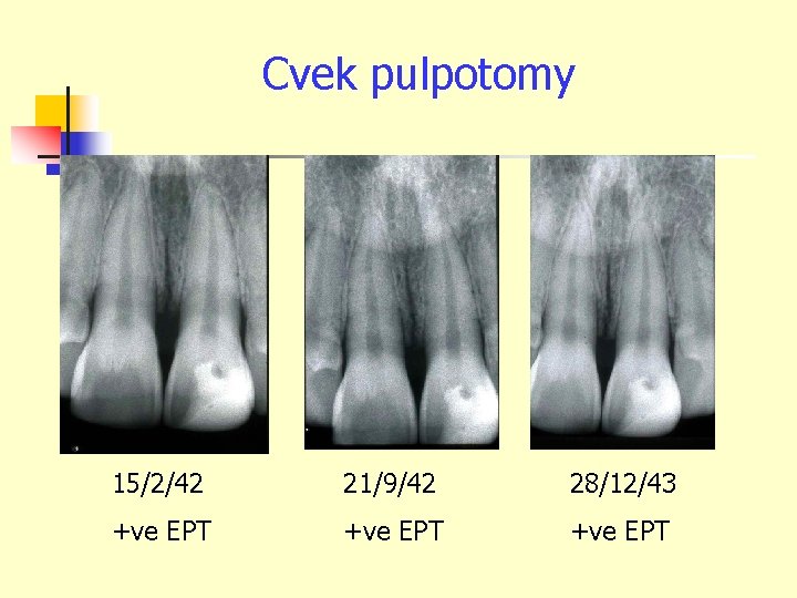 Cvek pulpotomy 15/2/42 21/9/42 28/12/43 +ve EPT 