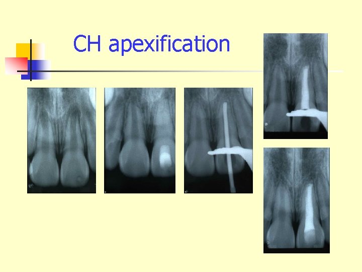 CH apexification 