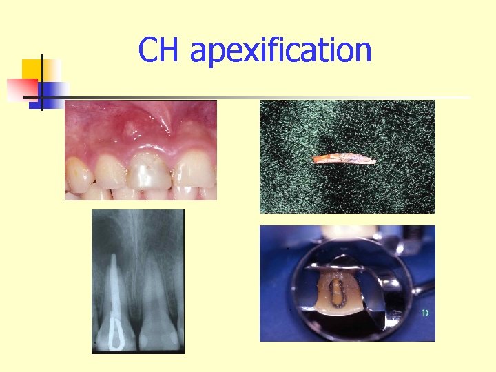 CH apexification 