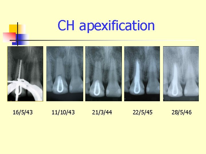 CH apexification 16/5/43 11/10/43 21/3/44 22/5/45 28/5/46 