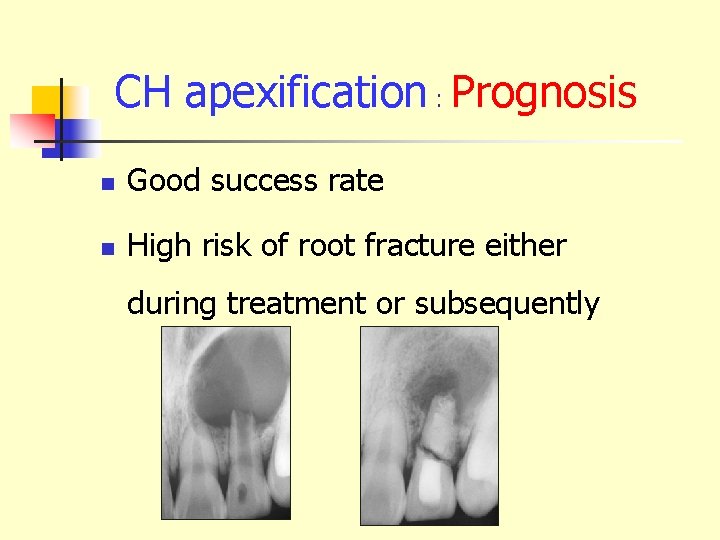 CH apexification : Prognosis n Good success rate n High risk of root fracture