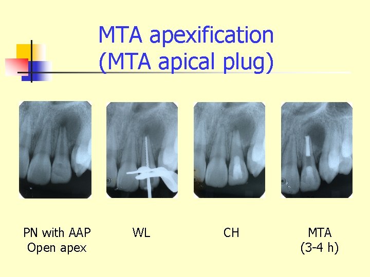 MTA apexification (MTA apical plug) PN with AAP Open apex WL CH MTA (3