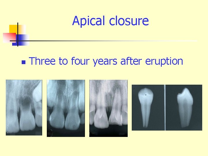 Apical closure n Three to four years after eruption 