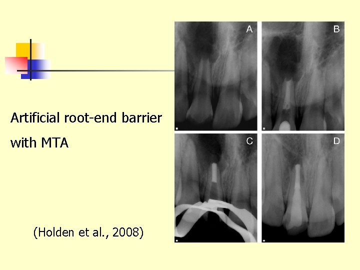 Artificial root-end barrier with MTA (Holden et al. , 2008) 