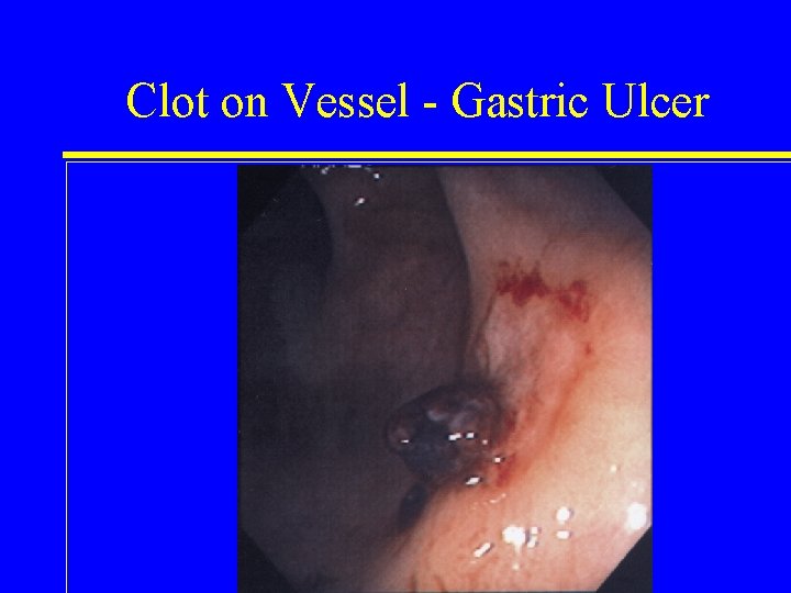 Clot on Vessel - Gastric Ulcer 