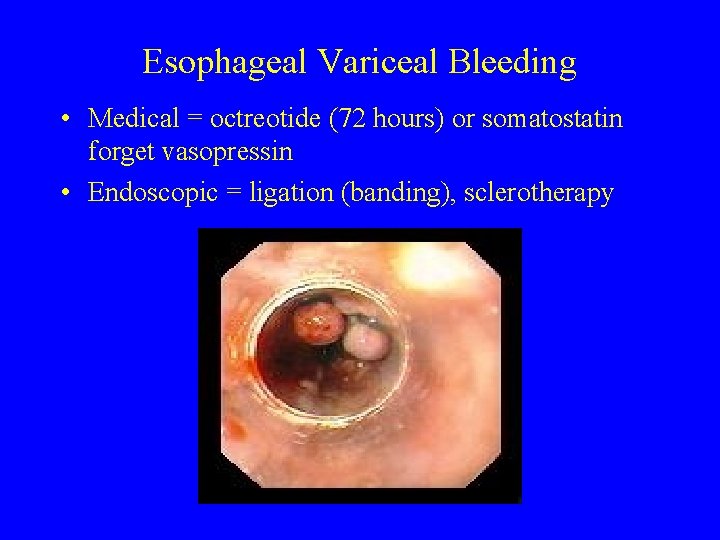 Esophageal Variceal Bleeding • Medical = octreotide (72 hours) or somatostatin forget vasopressin •