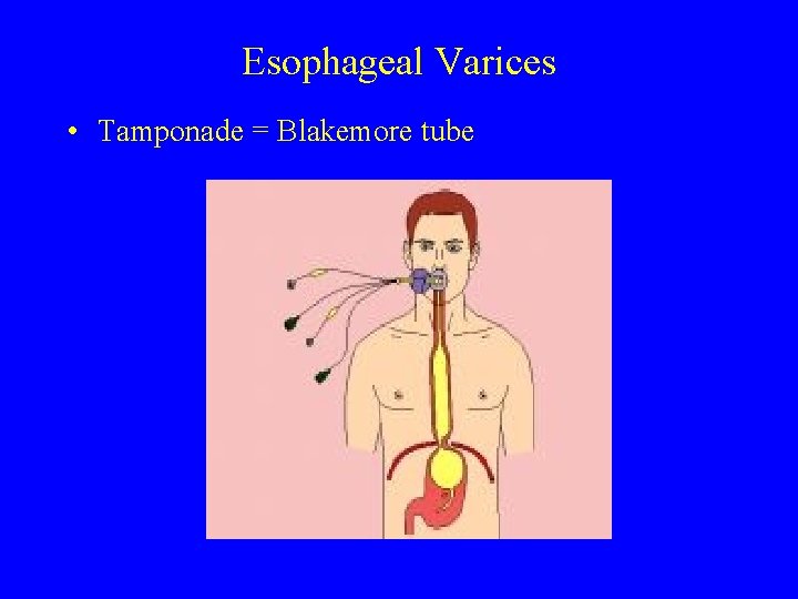Esophageal Varices • Tamponade = Blakemore tube 