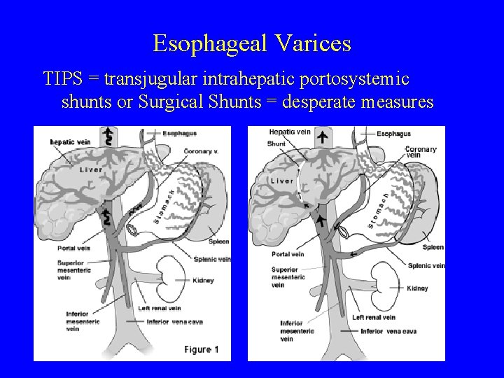 Esophageal Varices TIPS = transjugular intrahepatic portosystemic shunts or Surgical Shunts = desperate measures