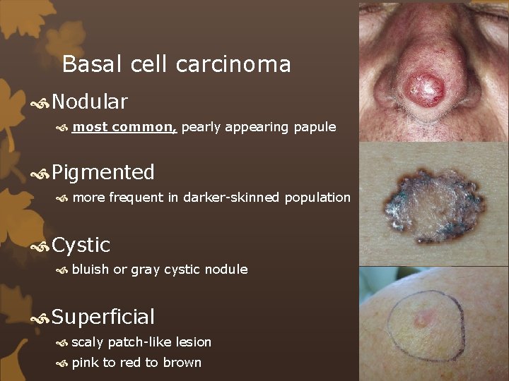 Basal cell carcinoma Nodular most common, pearly appearing papule Pigmented more frequent in darker-skinned