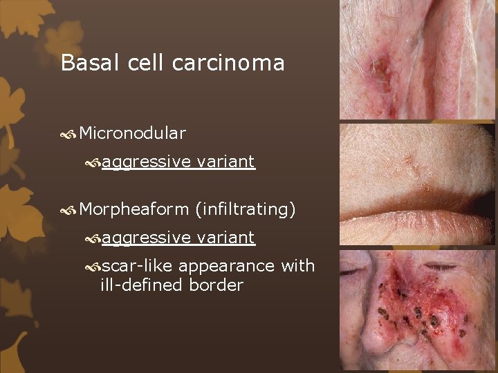 Basal cell carcinoma Micronodular aggressive variant Morpheaform (infiltrating) aggressive variant scar-like appearance with ill-defined