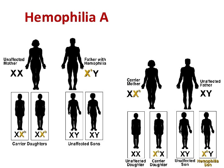 Hemophilia A 