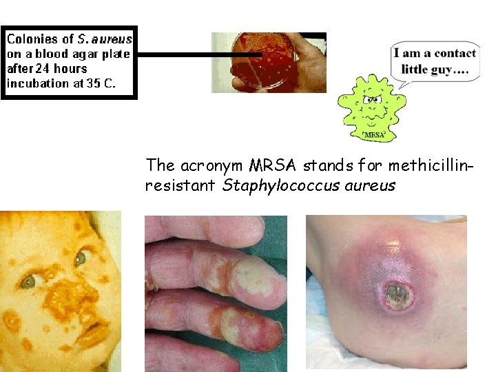 The acronym MRSA stands for methicillinresistant Staphylococcus aureus 