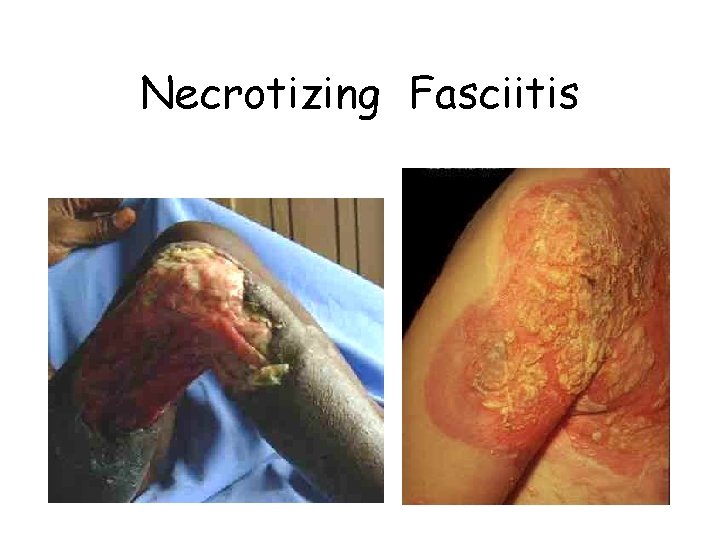 Necrotizing Fasciitis 