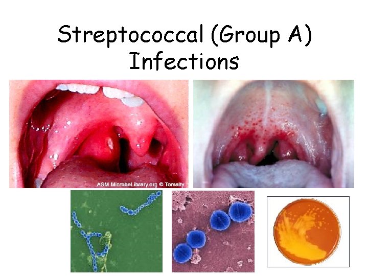 Streptococcal (Group A) Infections 