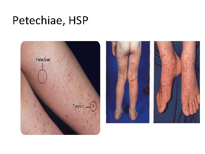 Petechiae, HSP 