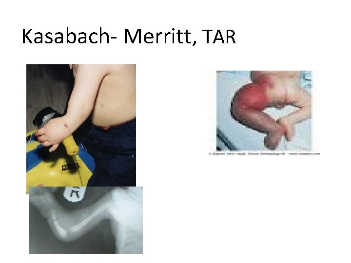 Kasabach- Merritt, TAR 