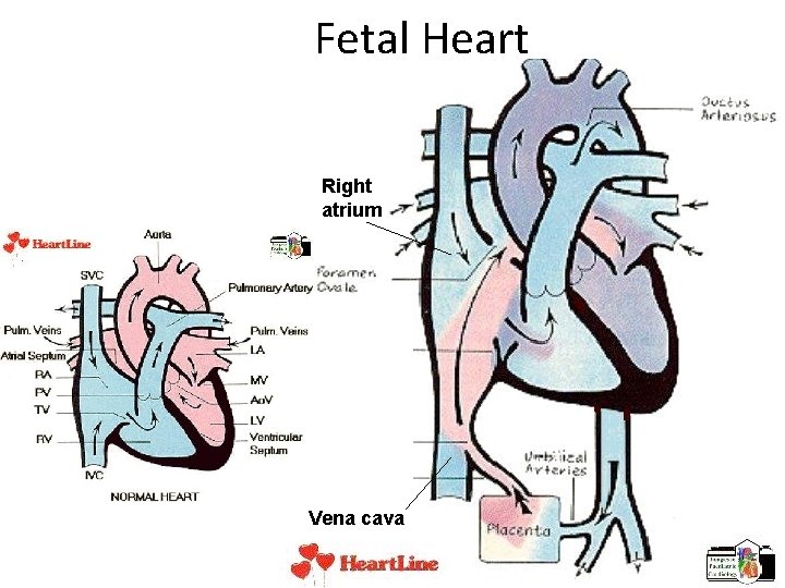 Fetal Heart Right atrium Vena cava 