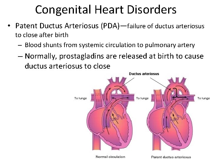 Congenital Heart Disorders • Patent Ductus Arteriosus (PDA)—failure of ductus arteriosus to close after