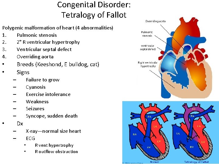 Congenital Disorder: Tetralogy of Fallot Polygenic malformation of heart (4 abnormalities) 1. Pulmonic stenosis