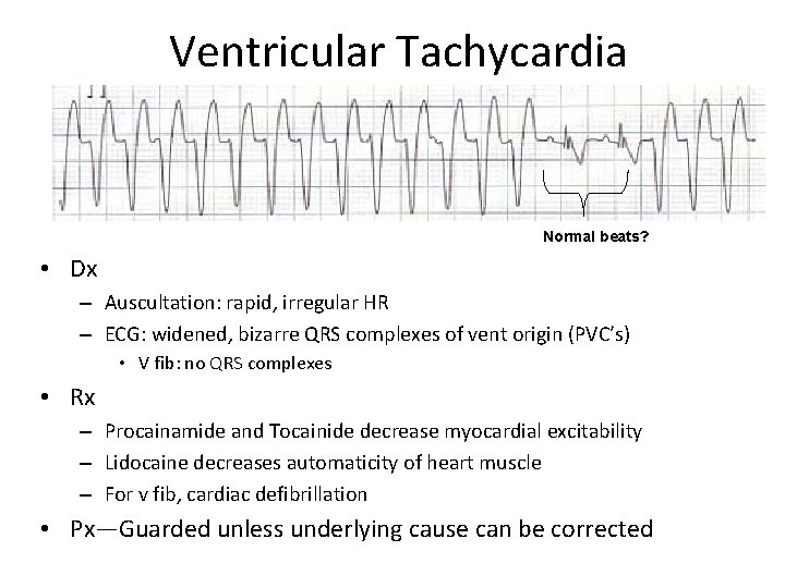 Ventricular Tachycardia Normal beats? • Dx – Auscultation: rapid, irregular HR – ECG: widened,