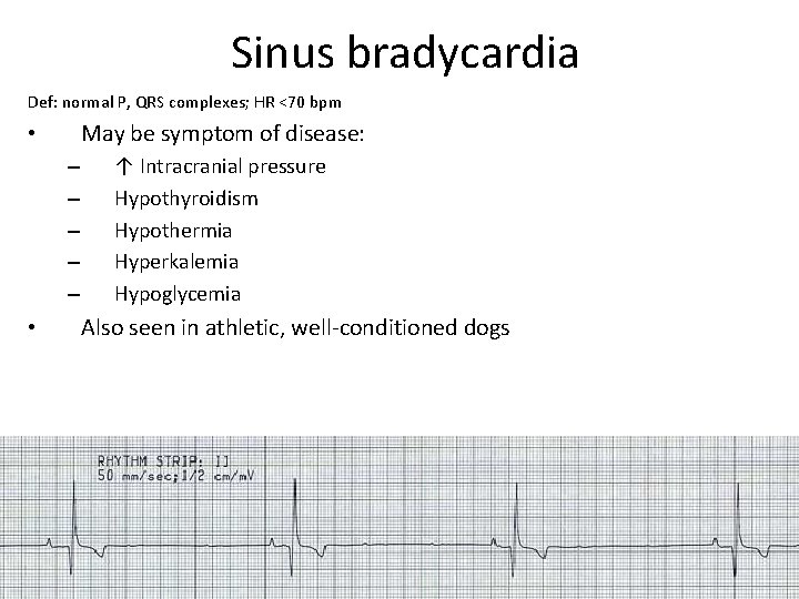 Sinus bradycardia Def: normal P, QRS complexes; HR <70 bpm May be symptom of