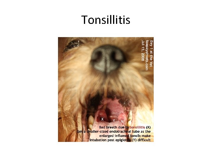 Tonsillitis 