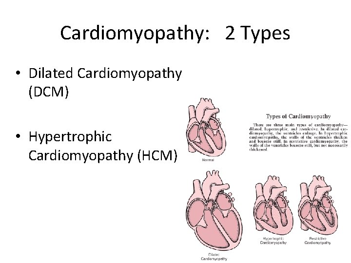 Cardiomyopathy: 2 Types • Dilated Cardiomyopathy (DCM) • Hypertrophic Cardiomyopathy (HCM) 