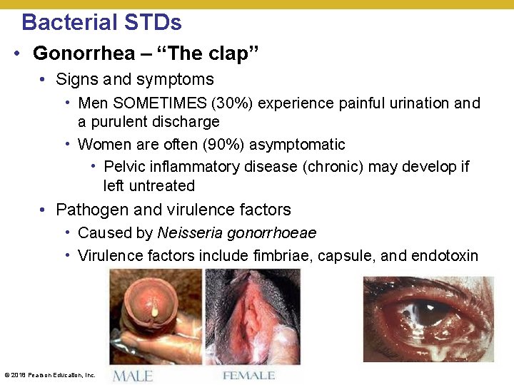Bacterial STDs • Gonorrhea – “The clap” • Signs and symptoms • Men SOMETIMES