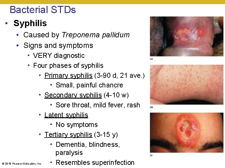 Bacterial STDs • Syphilis • Caused by Treponema pallidum • Signs and symptoms •