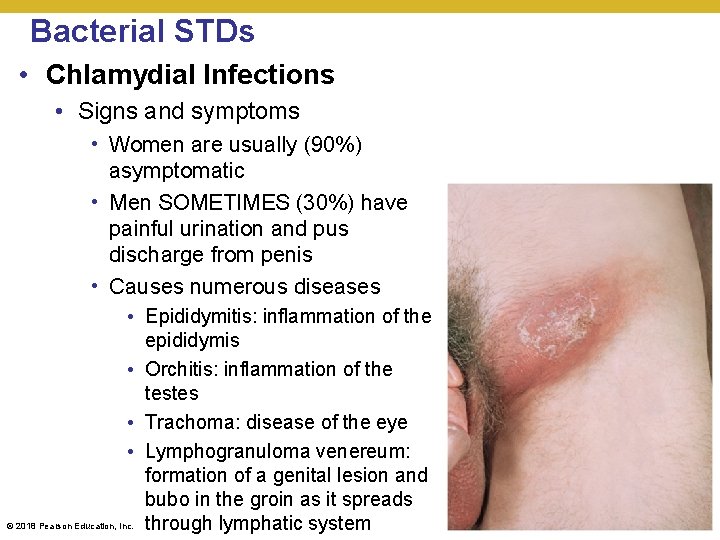 Bacterial STDs • Chlamydial Infections • Signs and symptoms • Women are usually (90%)