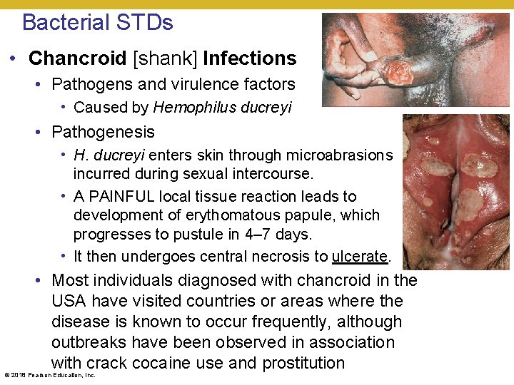 Bacterial STDs • Chancroid [shank] Infections • Pathogens and virulence factors • Caused by