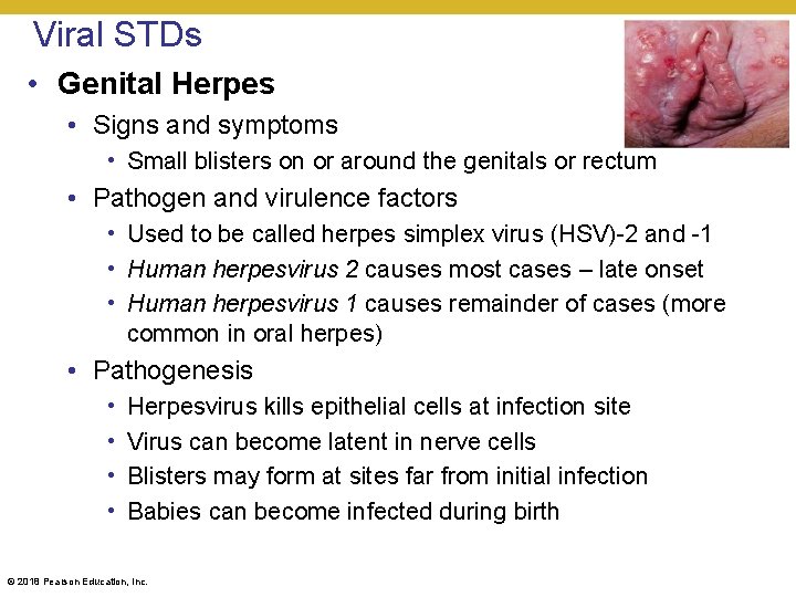 Viral STDs • Genital Herpes • Signs and symptoms • Small blisters on or