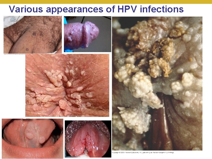 Various appearances of HPV infections © 2018 Pearson Education, Inc. 