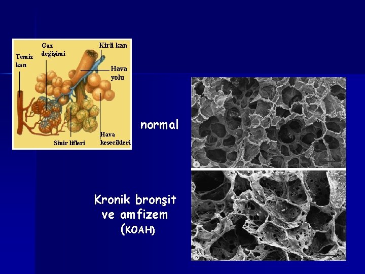 Temiz kan Gaz değişimi Kirli kan Hava yolu Sinir lifleri Hava kesecikleri normal Kronik