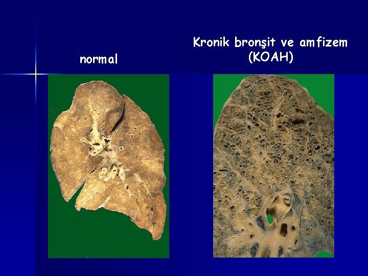 normal Kronik bronşit ve amfizem (KOAH) 