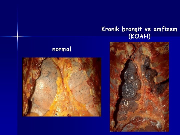 Kronik bronşit ve amfizem (KOAH) normal 