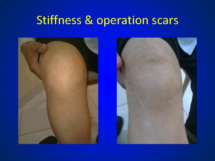 Stiffness & operation scars 