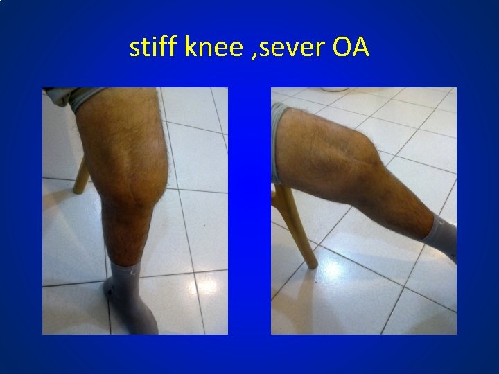 stiff knee , sever OA 