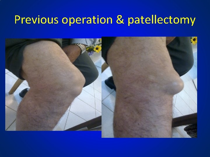 Previous operation & patellectomy 
