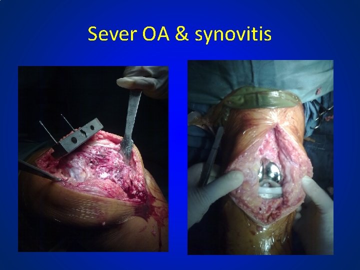 Sever OA & synovitis 
