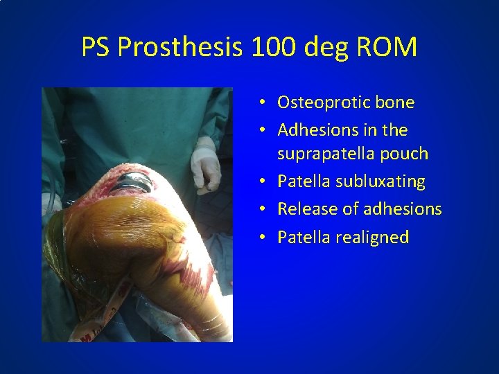 PS Prosthesis 100 deg ROM • Osteoprotic bone • Adhesions in the suprapatella pouch
