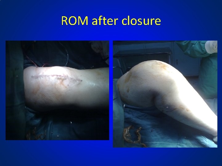 ROM after closure 