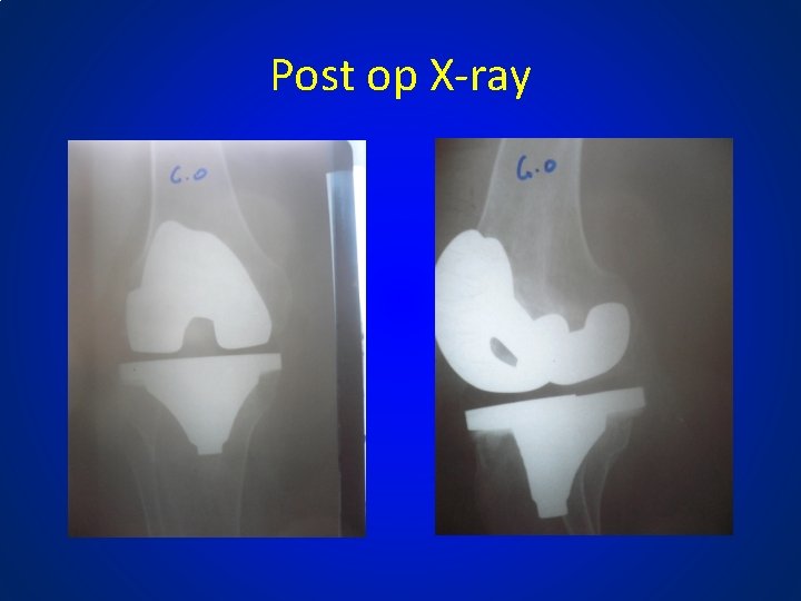 Post op X-ray 