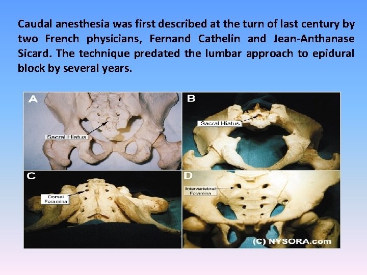 Caudal anesthesia was first described at the turn of last century by two French