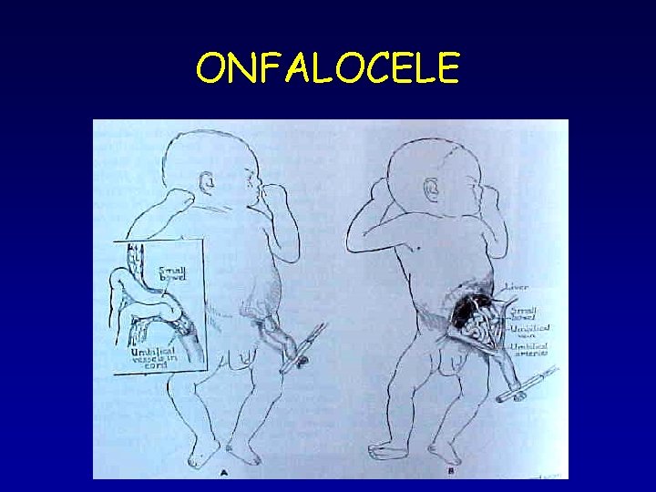 ONFALOCELE ONFALOCELE