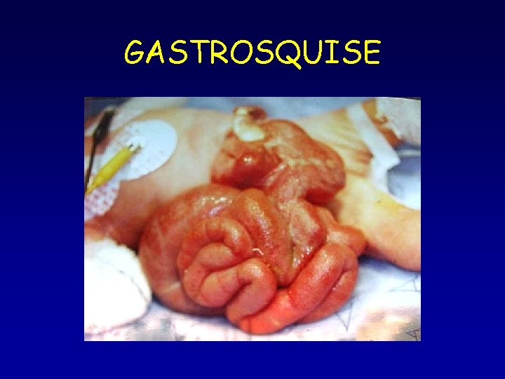 GASTROSQUISE GASTROSQUISE