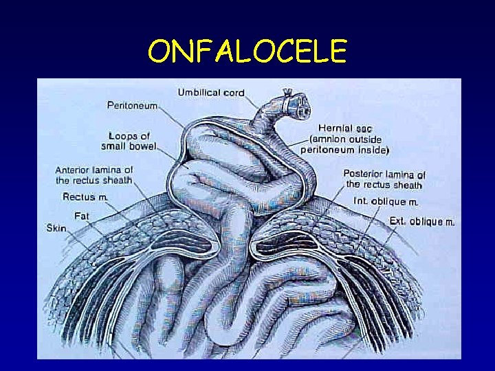 ONFALOCELE ONFALOCELE