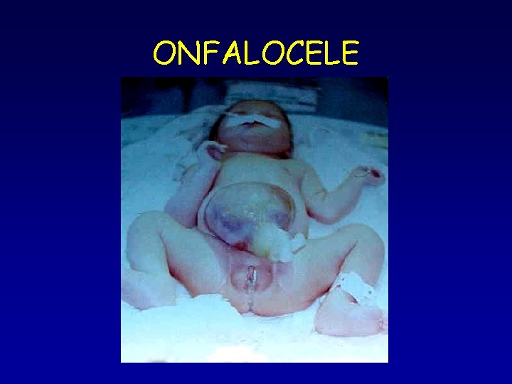 ONFALOCELE ONFALOCELE