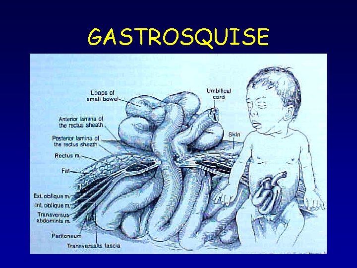 GASTROSQUISE GASTROSQUISE